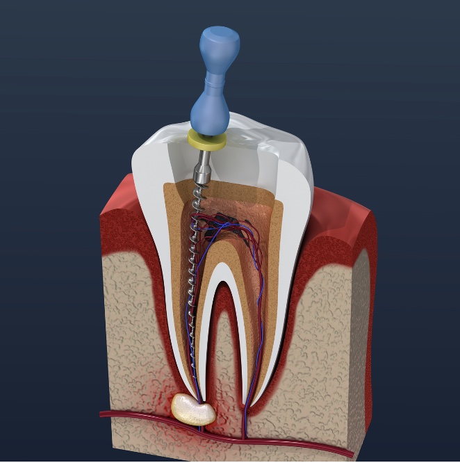 P340 Endodontic Series thumbnail