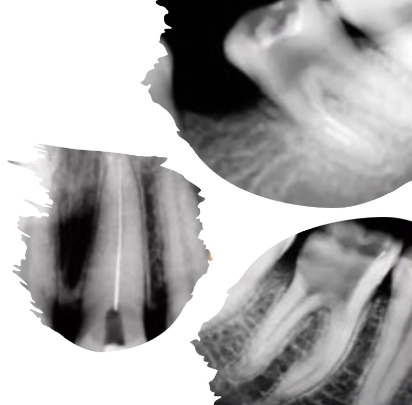 P339 Management of Iatrogenic Mishaps in Endodontics thumbnail