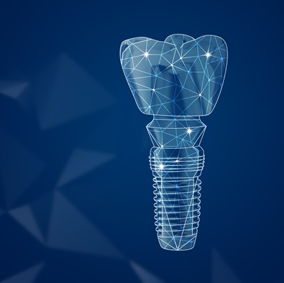 Image representing P395 The Biomechanical Principles of Restoring Dental Implants – A GDP’s Perspective